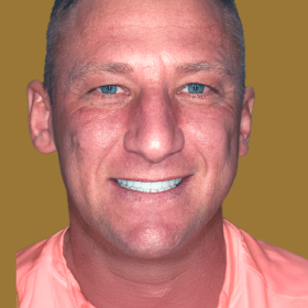   Smile Design
